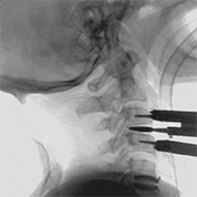 Moonray COMPACT neurosurgery neurosurgery