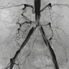 Moonray COMPACT vascular surgery vascular surgery